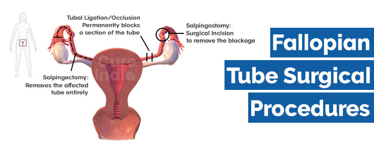  causes of tubal blockage